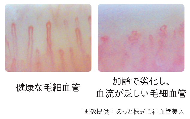 健康な毛細血管と、加齢で劣化し、血流が乏しい毛細血管（画像提供：あっと株式会社血管美人）